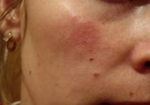 Príčiny a liečba dermatitídy na tvári
